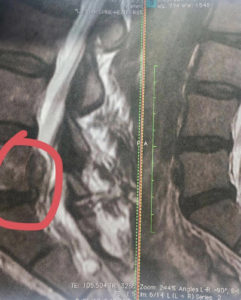 Back Pain and Underdeveloped Glutes