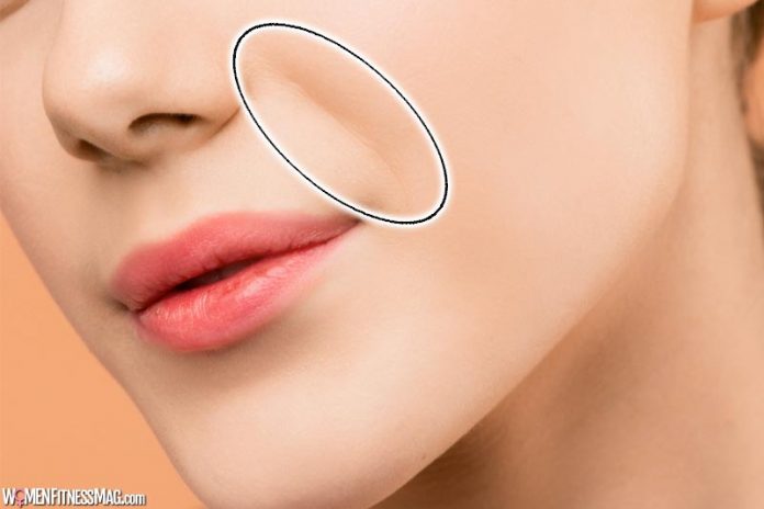 How To Get Rid of Nasolabial Folds
