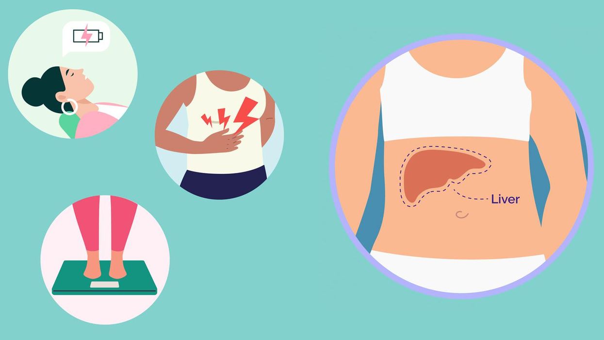 Enfermedad de hígado graso no alcohólico