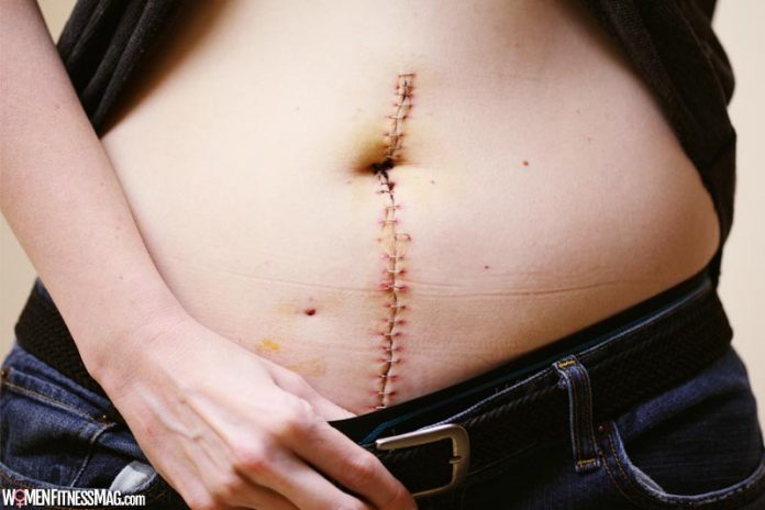 3 Tips for Recovering From an Operation