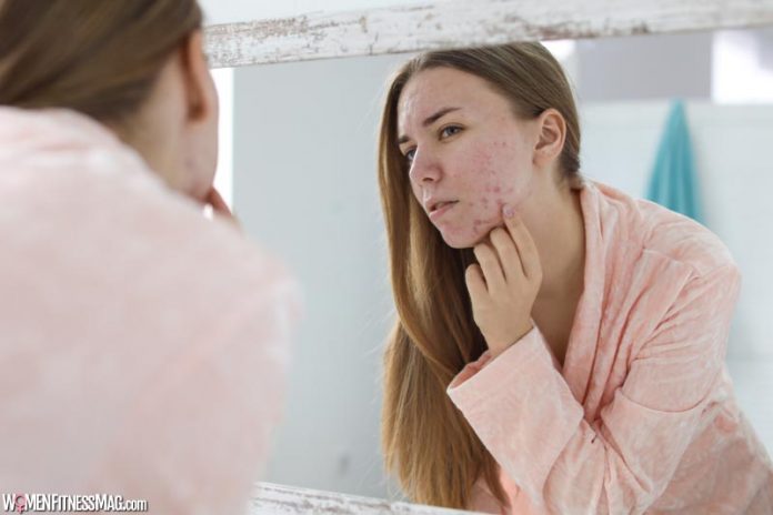 5 Natural Ways To Treat Skin Blemishes