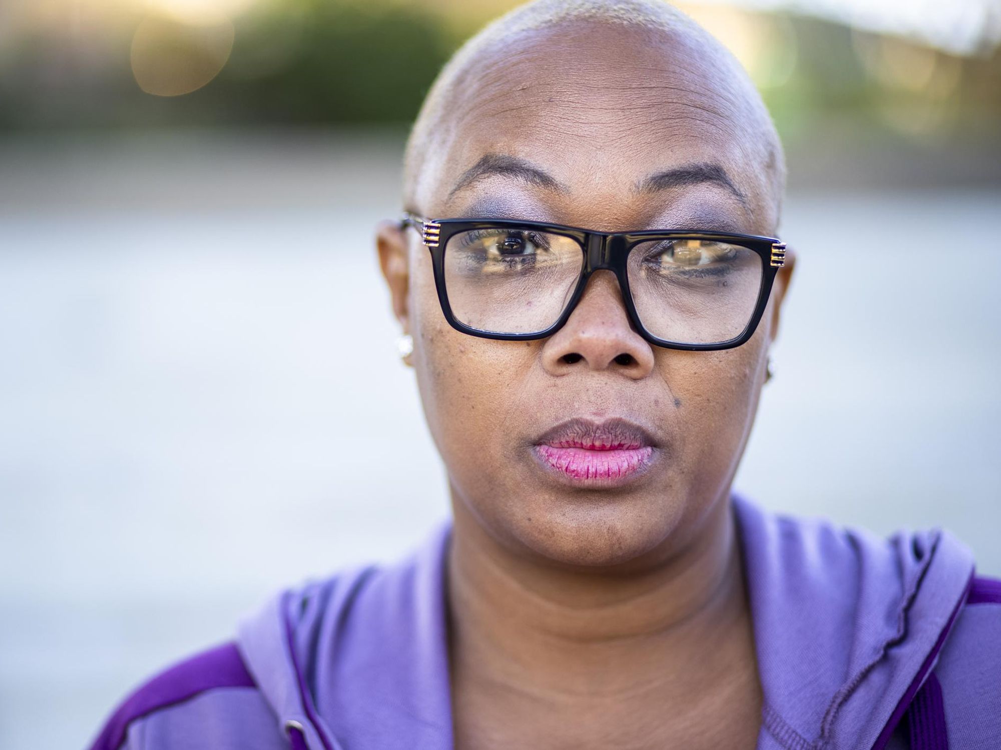 What Is Alopecia? It’s No Laughing Matter for Millions of Black American Women
