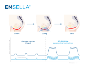 Emsella – the pelvic floor makeover treatment that will help cure your incontinence