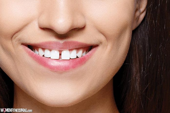 Composite Resin to Fix Gaps in Teeth