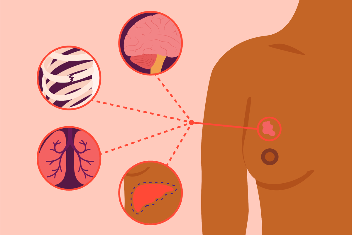 Where Metastatic Breast Cancer Can Spread in the Body