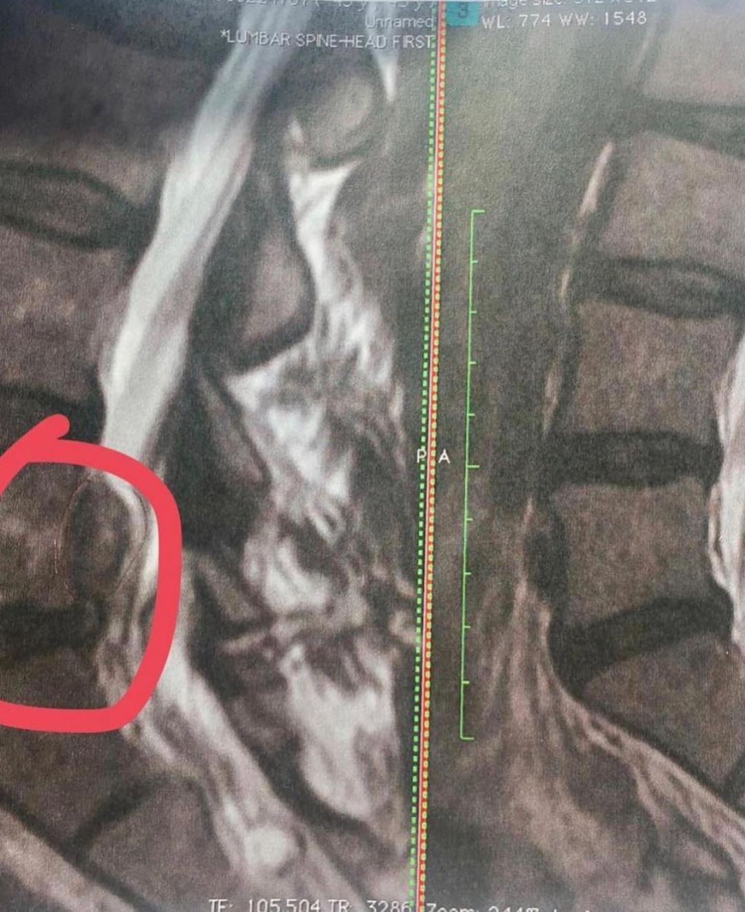 Back Pain: Inflammation, Excess Weight, and Underdeveloped Glutes