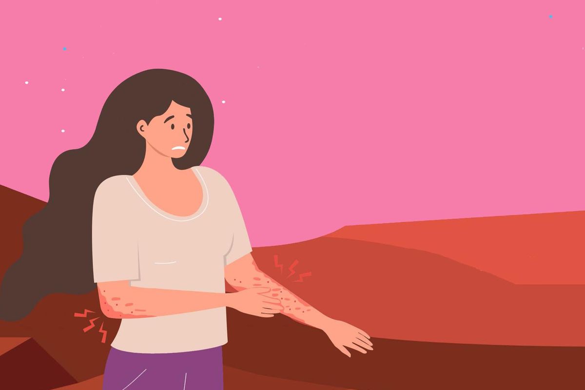 Type 2 Inflammation May Be Contributing to Your Atopic Dermatitis