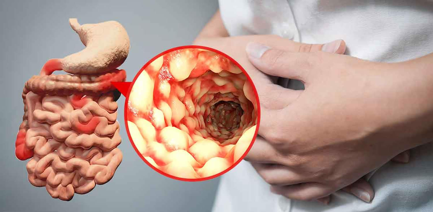 What is Crohn’s Disease?