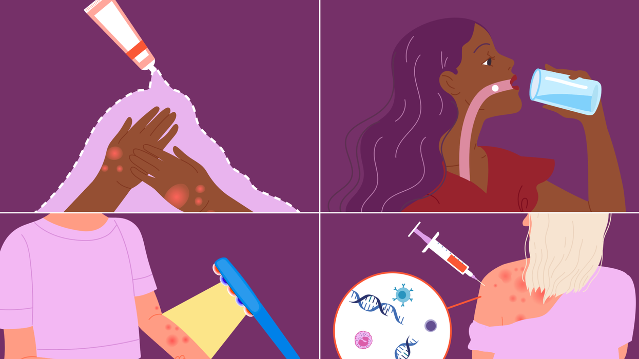 Options for Treating Atopic Dermatitis