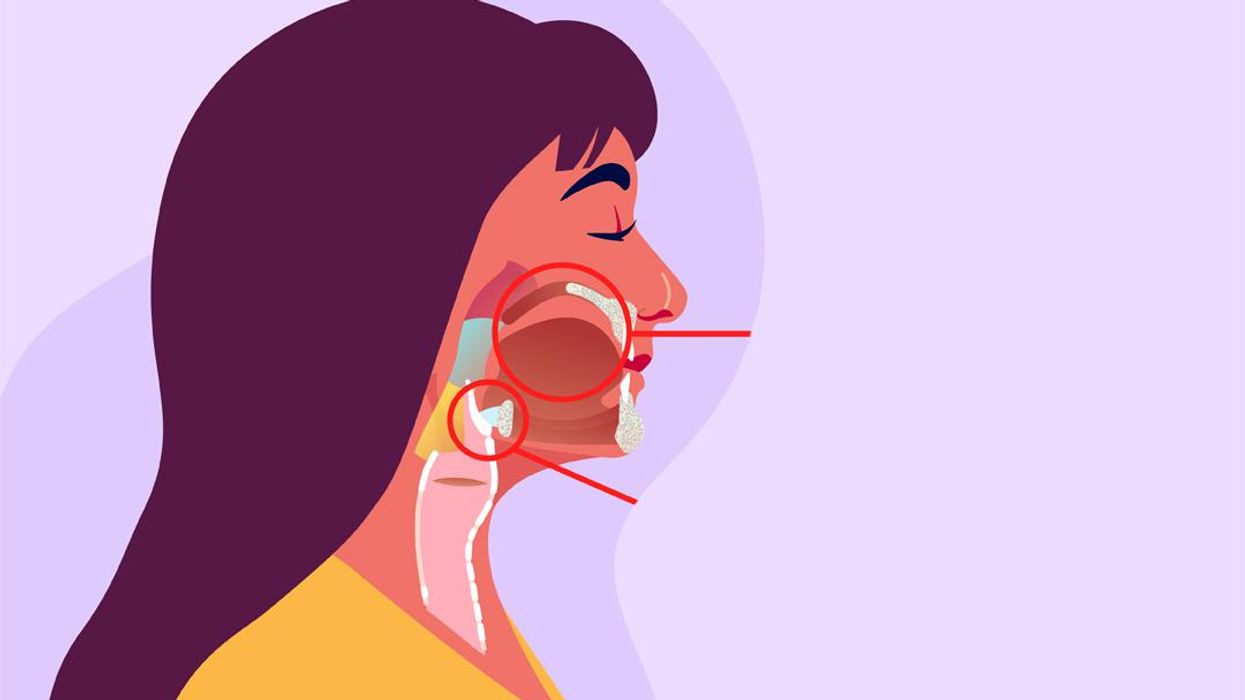 ¿Cuál es la conexión entre el VPH  y el cáncer de cabeza y cuello?