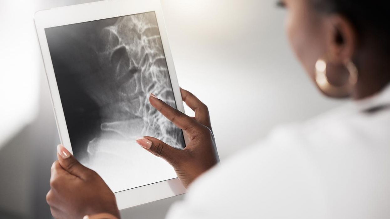 In an Aging America, Osteoporosis Is a Looming Public Health Crisis