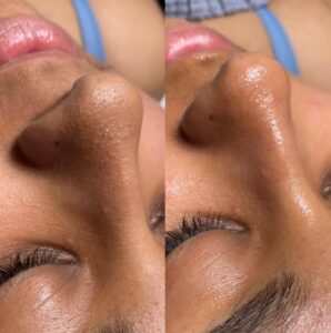 ‘Hydrafacial is the Rolls Royce of facials’ – a step by step review