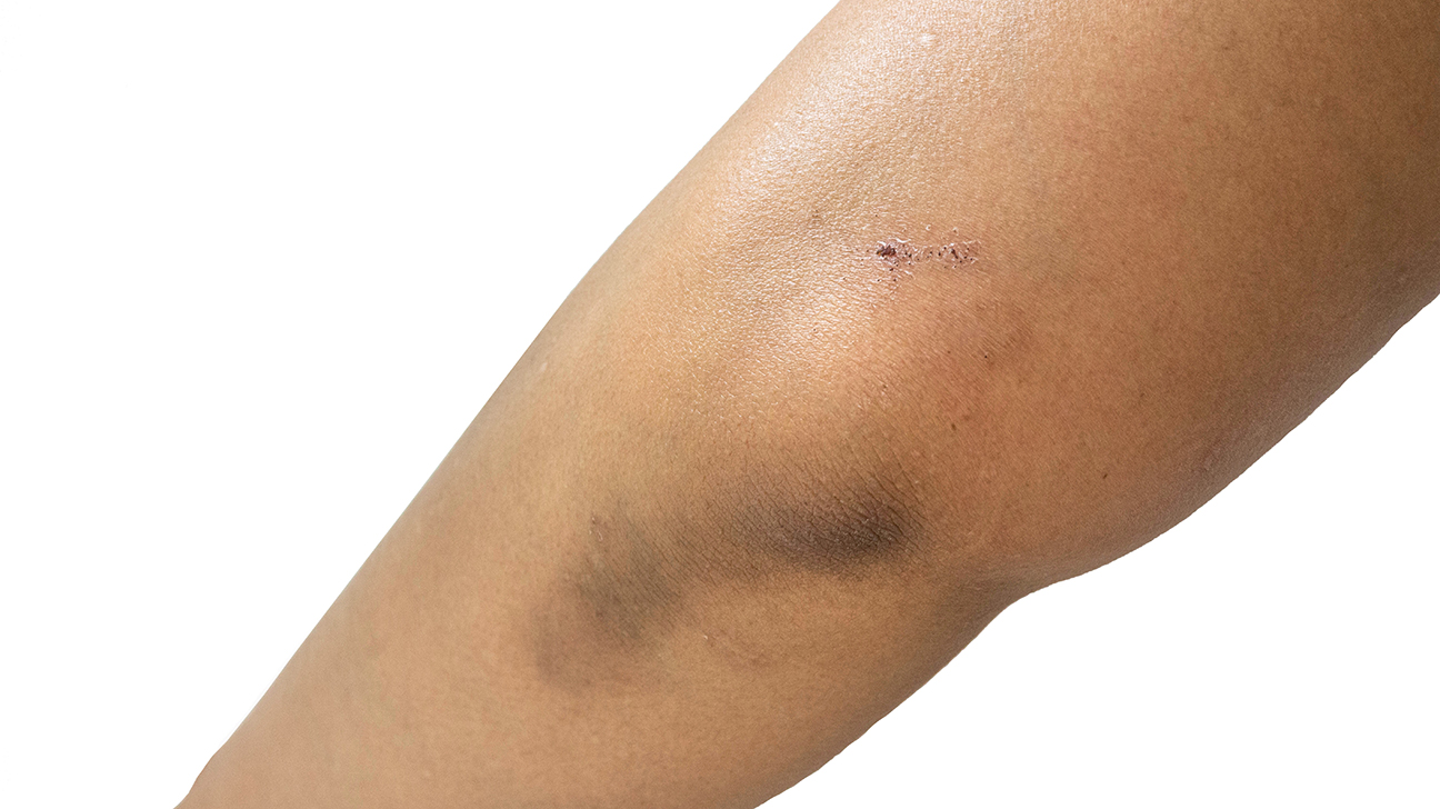 Insulin Resistance & How It Affects Skin