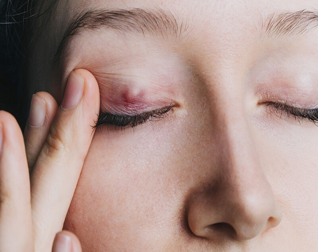 Chalazion or Eyelid Cyst
