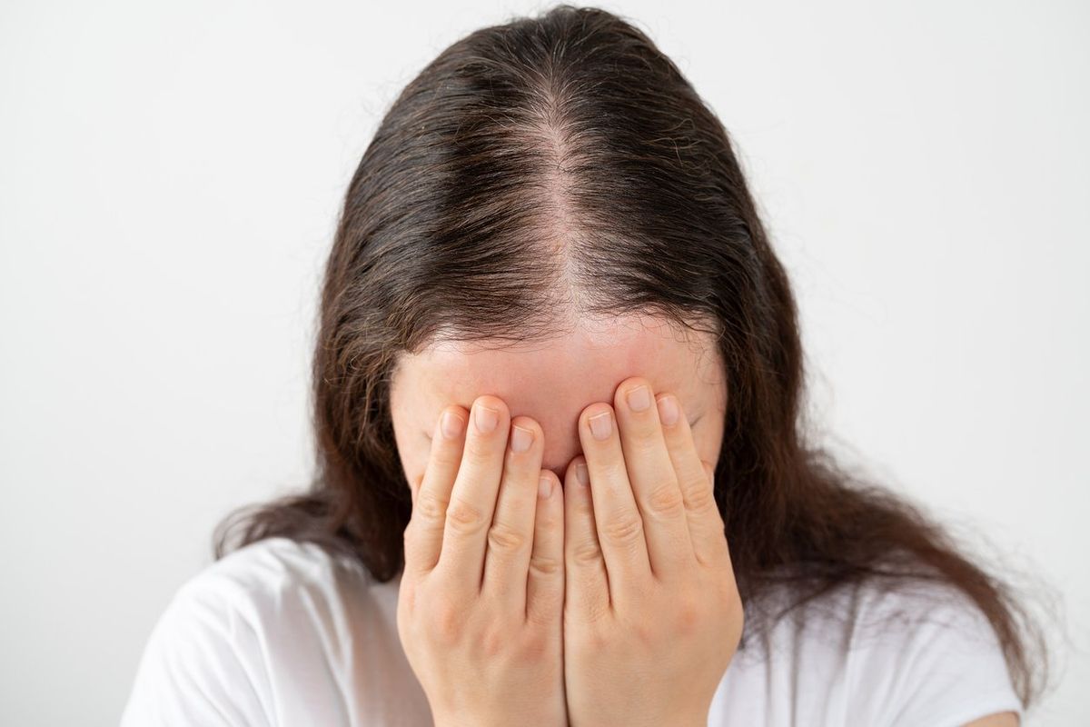 Hair Loss in Women