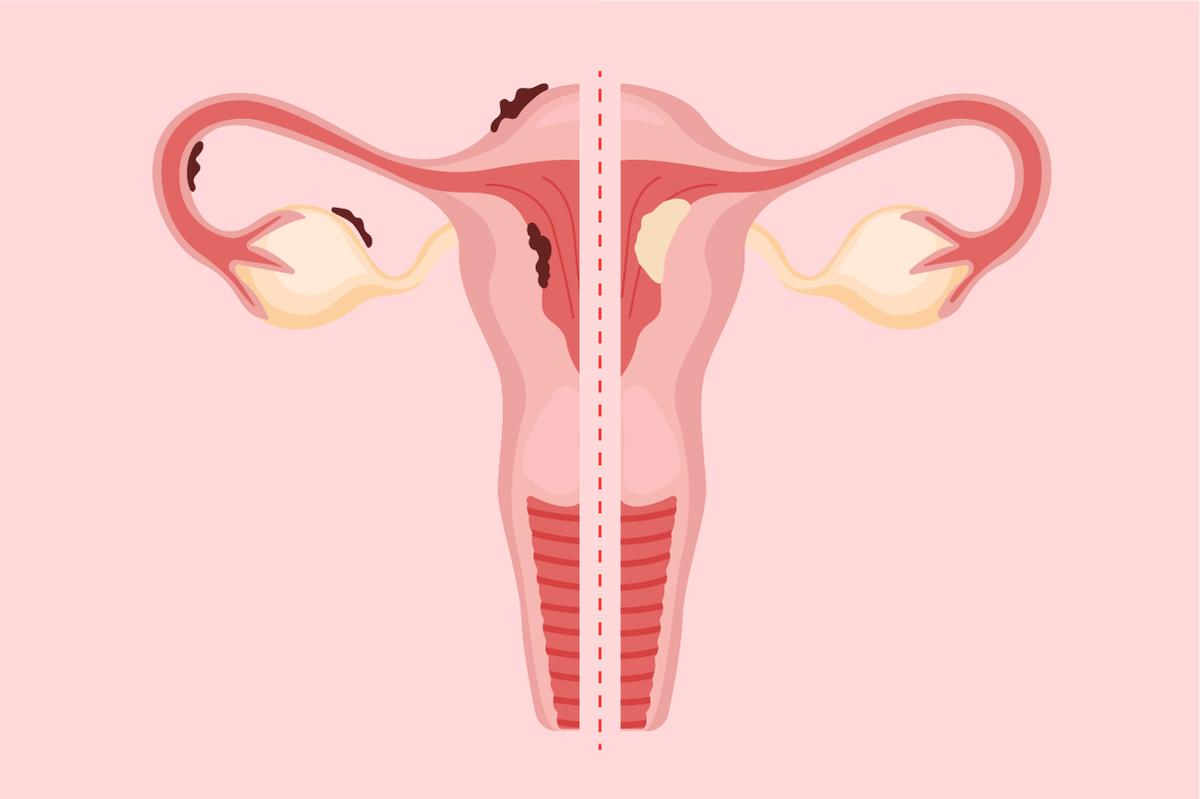 Is It Endometriosis or Endometrial Cancer?