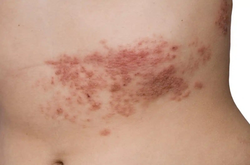 Unraveling the Painful Truth: Understanding Shingles and Its Impact