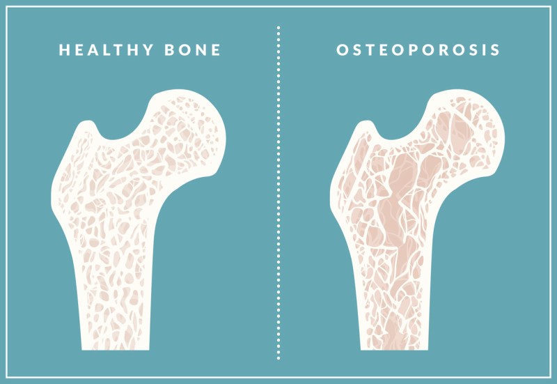 Avoid Osteoporosis with These 7 Dairy-Free Calcium Boosters