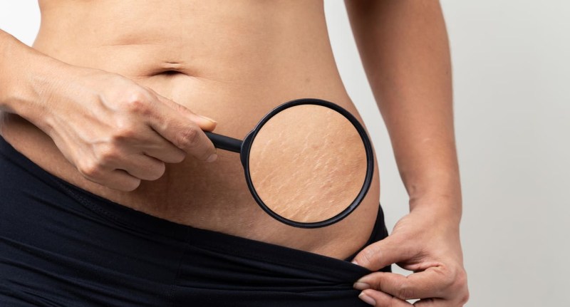 Stop the Streaks: Our Top Organic Stretch Mark Creams
