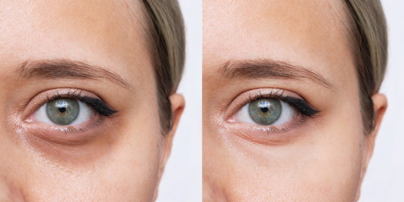 How to Cover Under-Eye Bags and Dark Circles