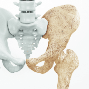 What You Need to Know About Osteoporosis