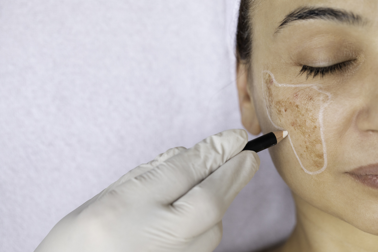 Best Treatments to Minimize Age Spots on Face & Hands