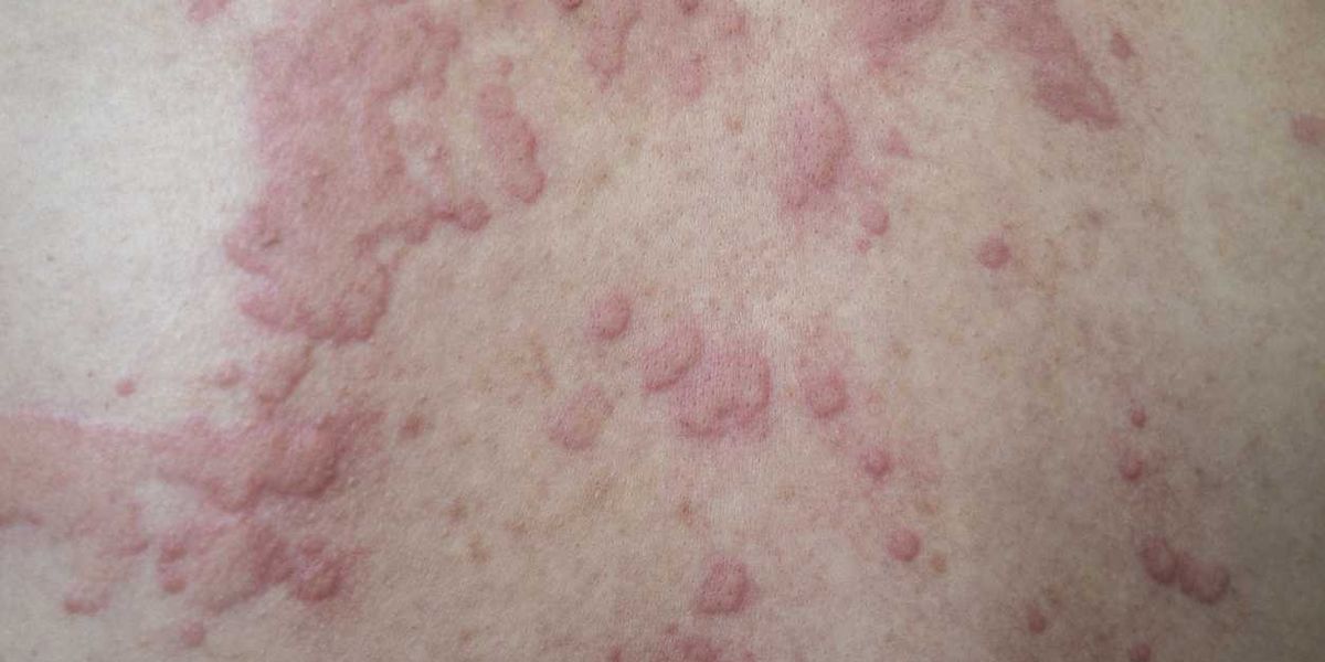 Chronic Spontaneous Urticaria 101 – HealthyWomen