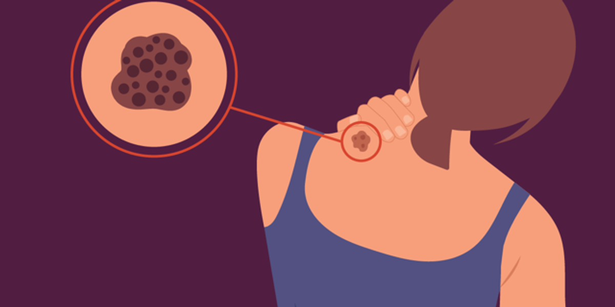 Types of Melanoma – HealthyWomen