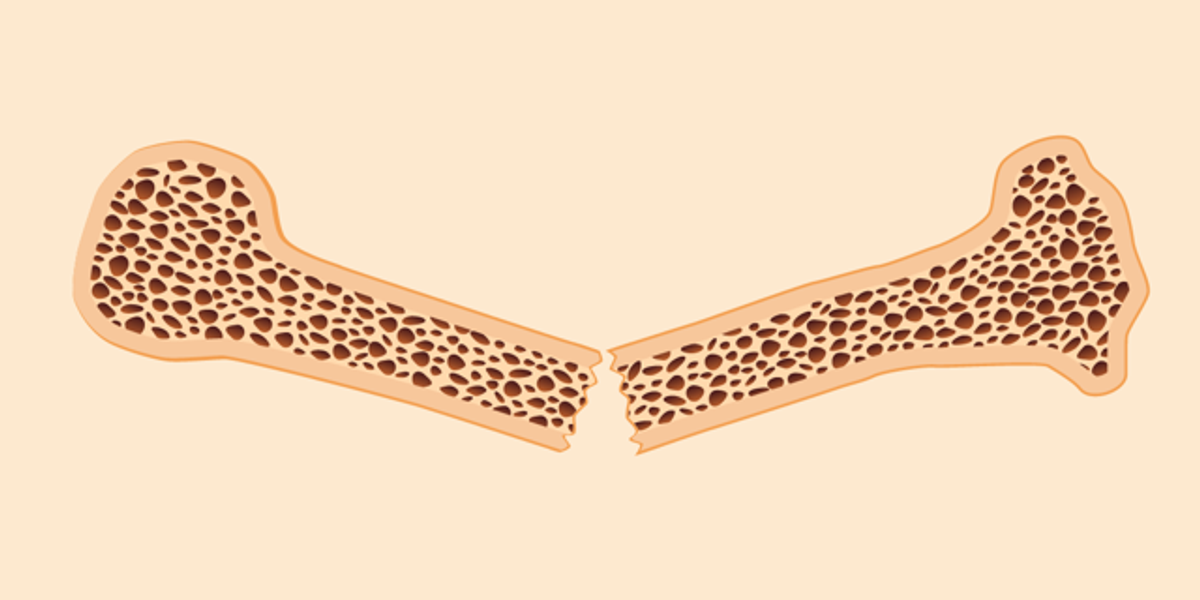 Osteoporosis Treatments – HealthyWomen