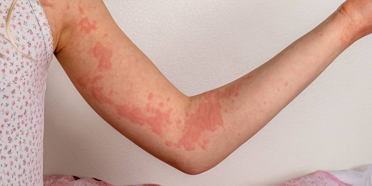 Managing chronic spontaneous urticaria – HealthyWomen