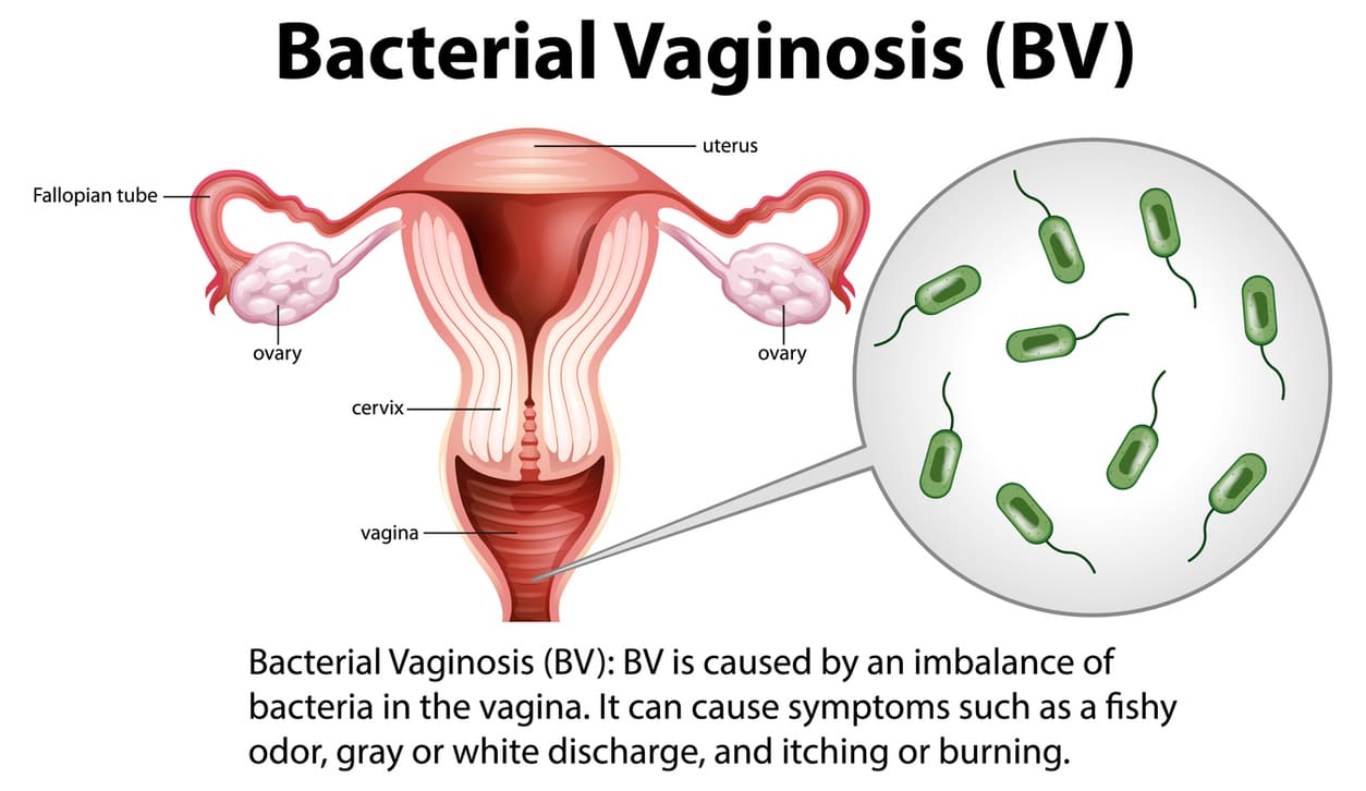 Navigating Bacterial Vaginosis – Prime Women