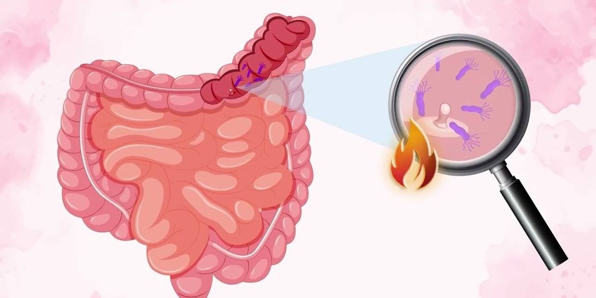 Gut Microbiome and Colorectal Cancer