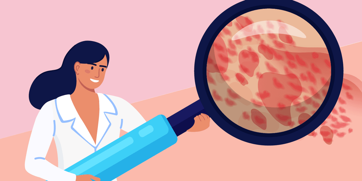 What Is Chronic Spontaneous Urticaria?