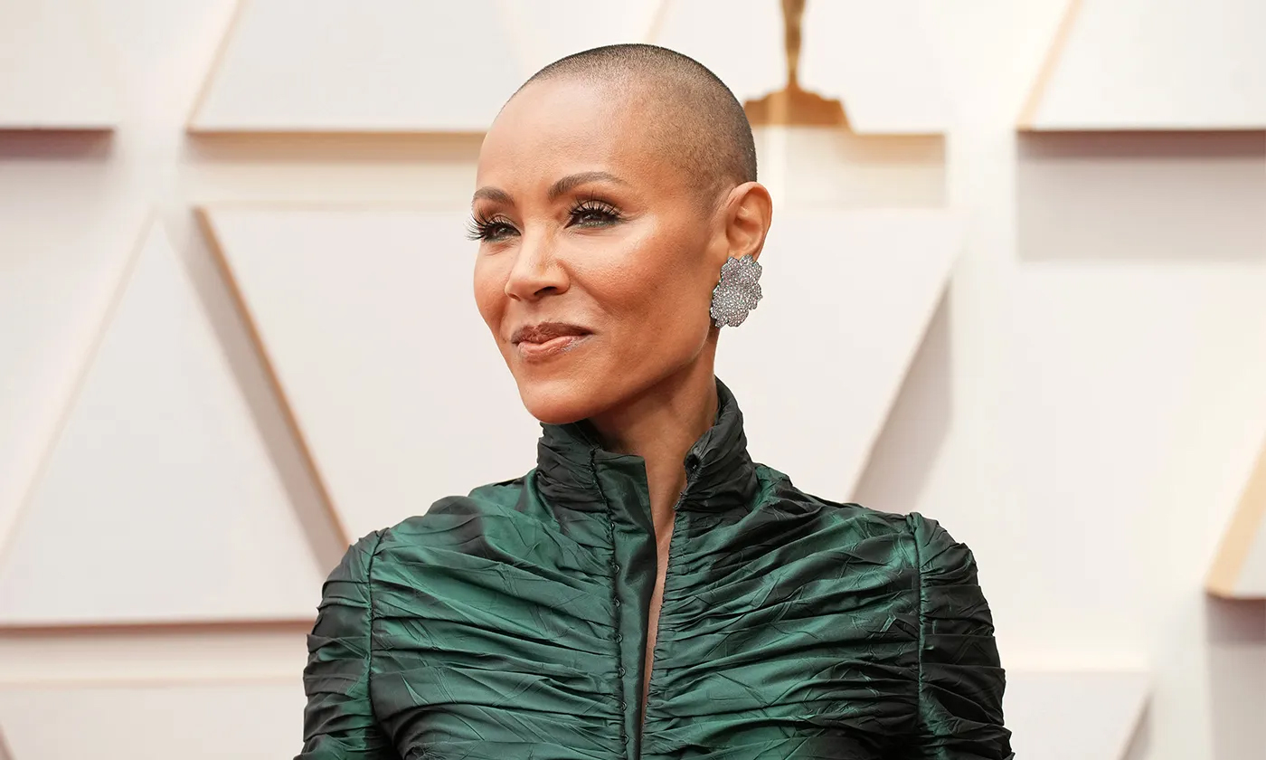 Alopecia in Women – Women Fitness
